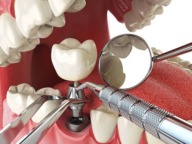 Best Emergency Root Canal Treatment in Albemarle, NC